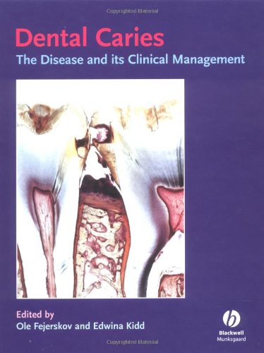 Dental Caries The Disease And Its Clinical Management Ole Fejerskov