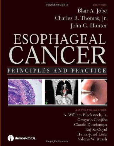 Esophageal Cancer Principles And Practice 1st Edition Blair A Jobe