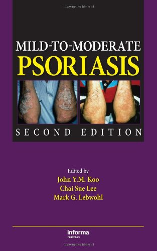 Mildtomoderate Psoriasis Second Edition 2nd Edition John Ym Koo