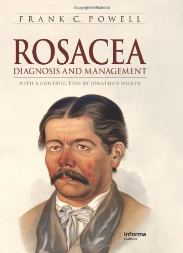 Rosacea Diagnosis And Management 1st Edition Frank Powell