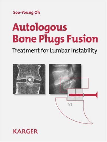 Autologous Bone Plugs Fusion Treatment For Lumbar Instability 3e Criteria Technical Operative Notes The Functioning Of The Ohs Screw 1st Edition Sooyoung Oh