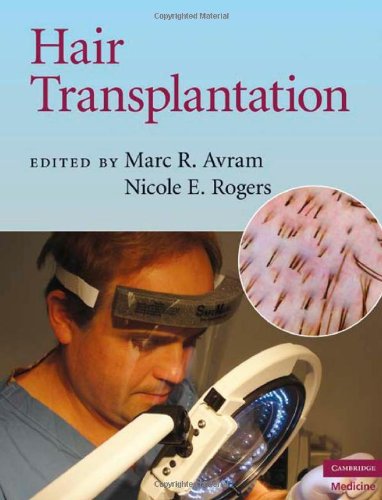 Hair Transplantation 1st Edition Marc R Avram Nicole E Rogers