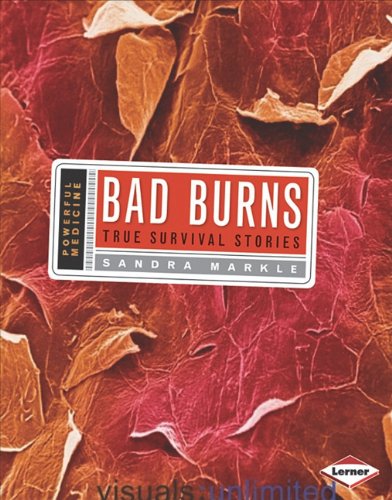 Bad Burns True Survival Stories Sandra Markle