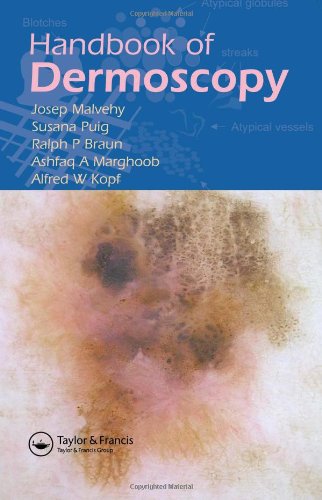 Handbook Of Dermoscopy 1st Edition Josep Malvehy Ralph P Braun