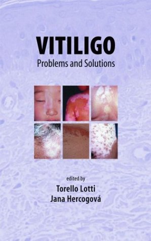 Vitiligo Problems And Solutions 1st Edition Torello Lotti Jana Hercogova