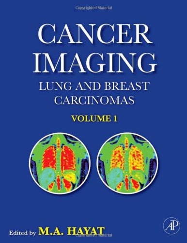 Cancer Imaging Volume 1 Lung And Breast Carcinomas Cancer Imaging 1st Edition M A Hayat